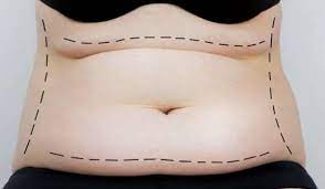 Embrace a New Body Image: Tummy Tuck in Miami