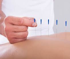 Holistic Healing: Exploring Acupuncture in Coquitlam