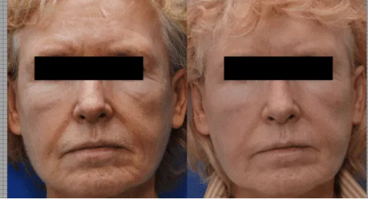 Trimming the Excess: Fat reduction for Enhanced Curves