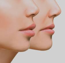 Lip Fillers: Cost and Cost