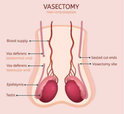 Kelowna’s Top Vasectomy Reversal Clinics: Your Path to Parenthood